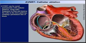 avnrt-catheter-ablation