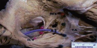 isthmus-ablation