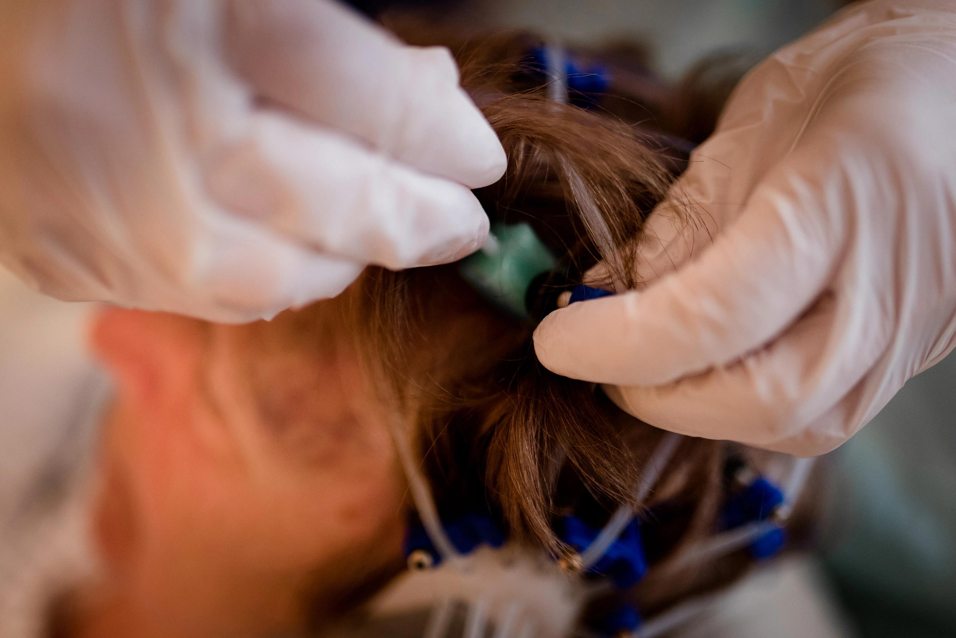 Bild: Elektroden werden am Kopf einer Patientin angebracht